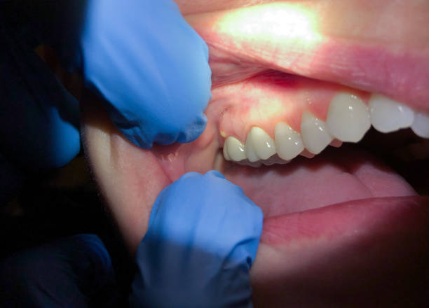Best Teeth Whitening  in Bernice, LA